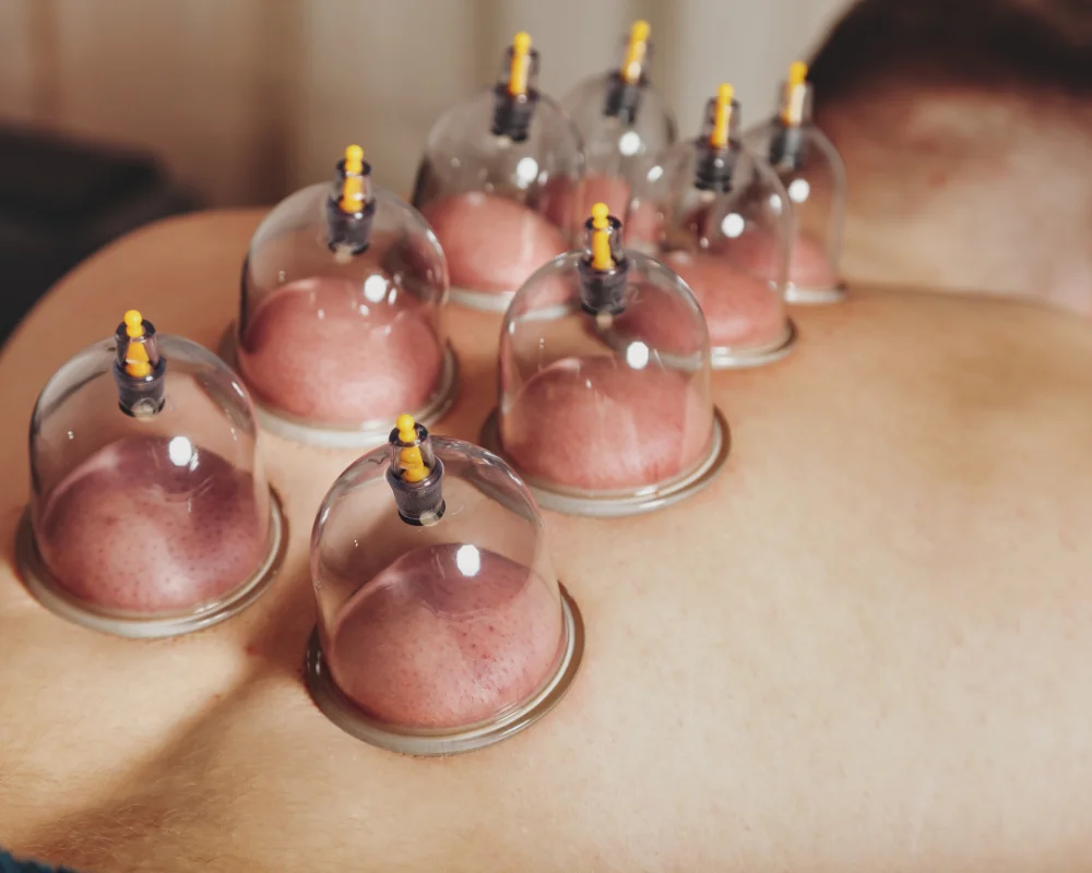 Cupping-Therapy-images