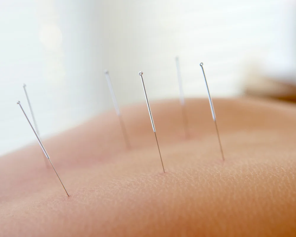 Dry-Needling-images