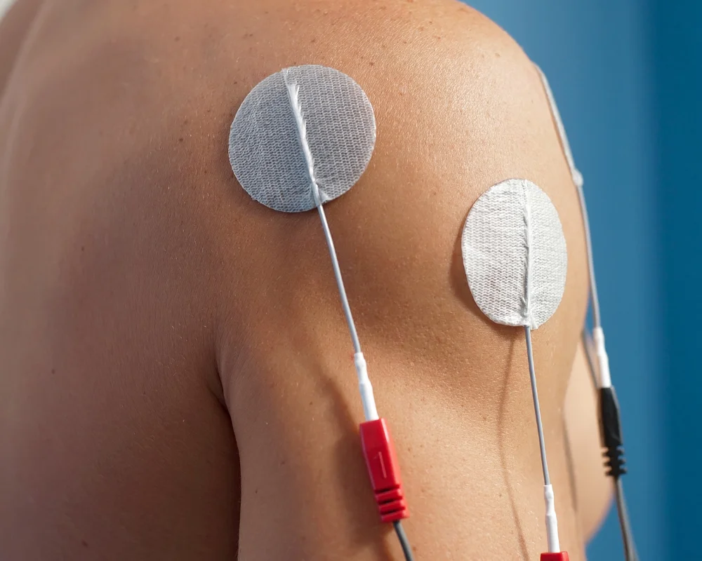 Electrical-Stimulation-images