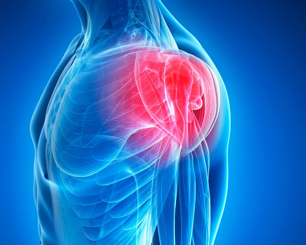 Frozen-Shoulder-pain-image