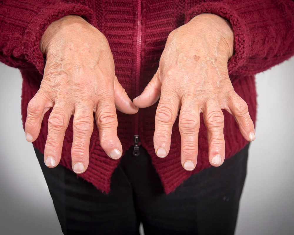 Rheumatoid-Arthritis-image